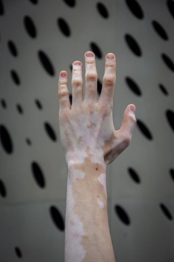 Hand and forearm with vitiligo, showing light patches of skin against a patterned background